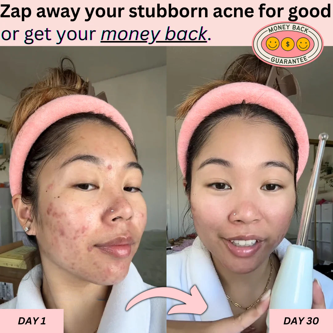 PrimaDerma™️ - High Frequency Derma Wand