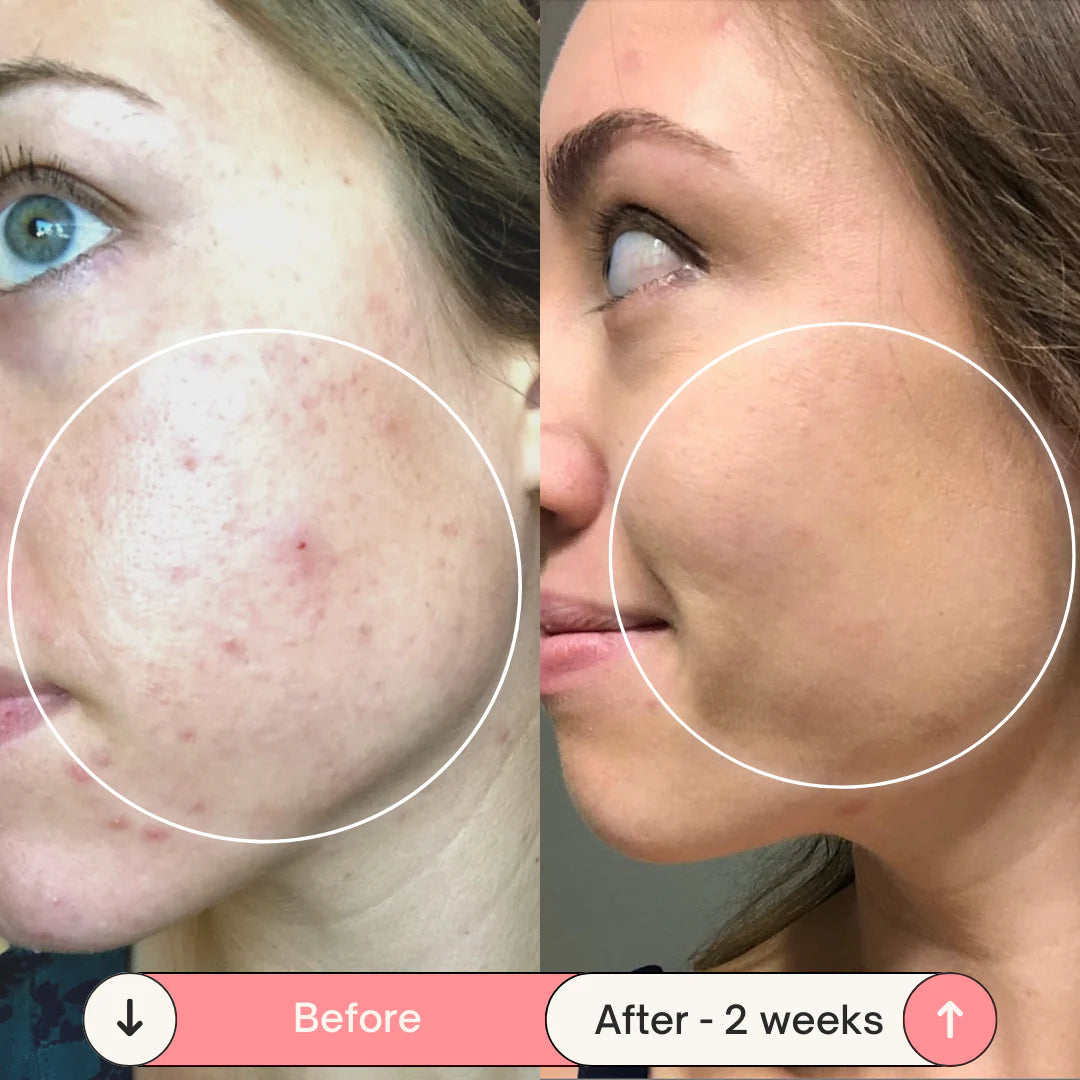 PrimaDerma™️ - High Frequency Derma Wand